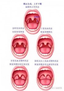 扁桃?扁桃体发炎最快治疗方法!